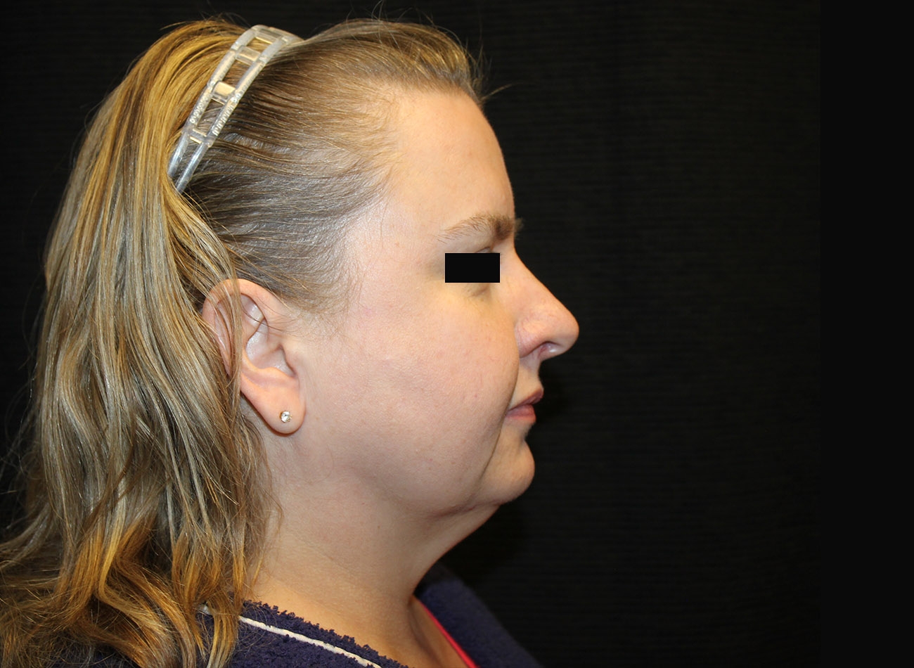 Patient #16939: FaceTite & Morpheus8 Before Image
