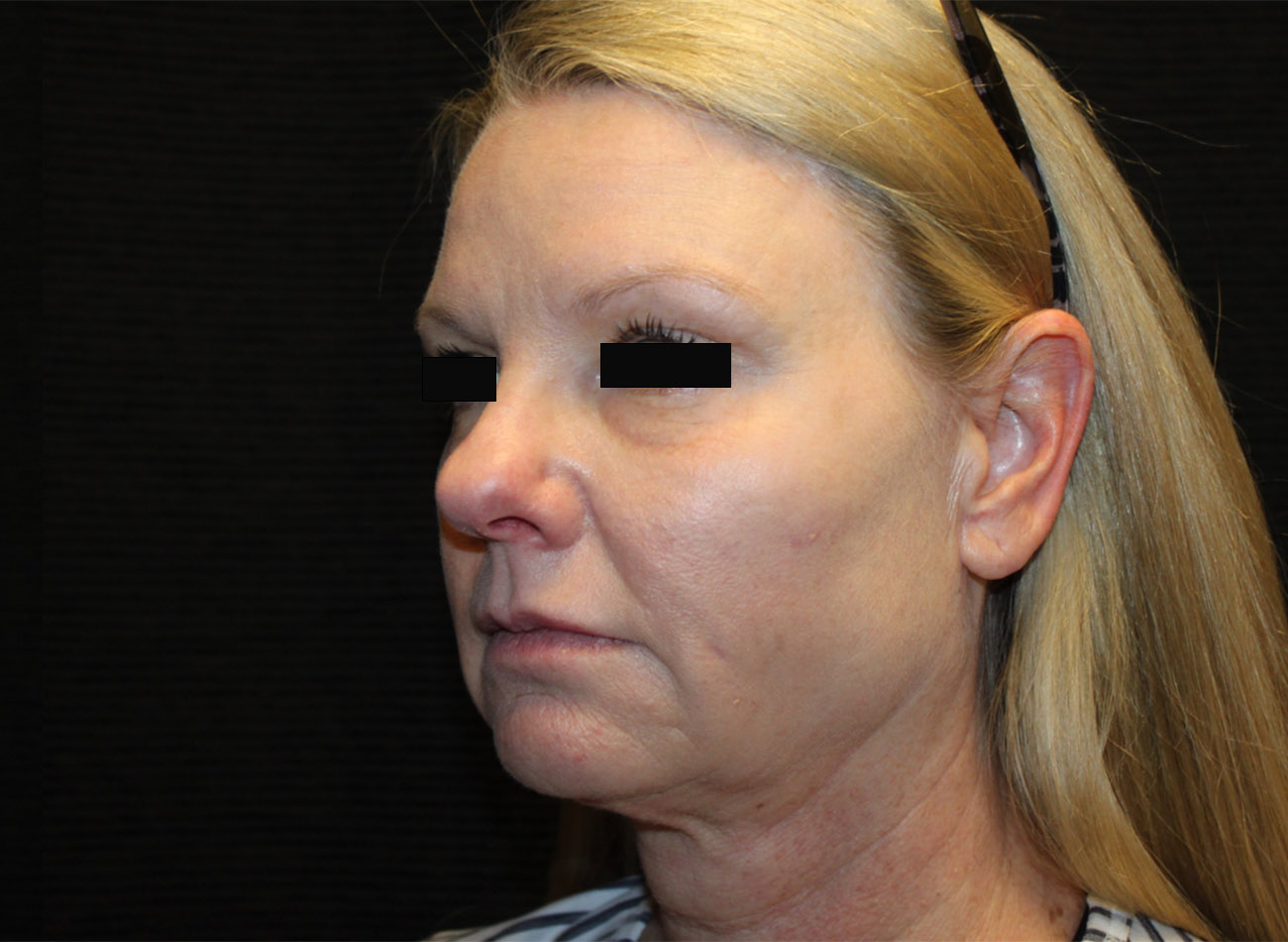 Patient #33784: FaceTite & Morpheus8 After Image