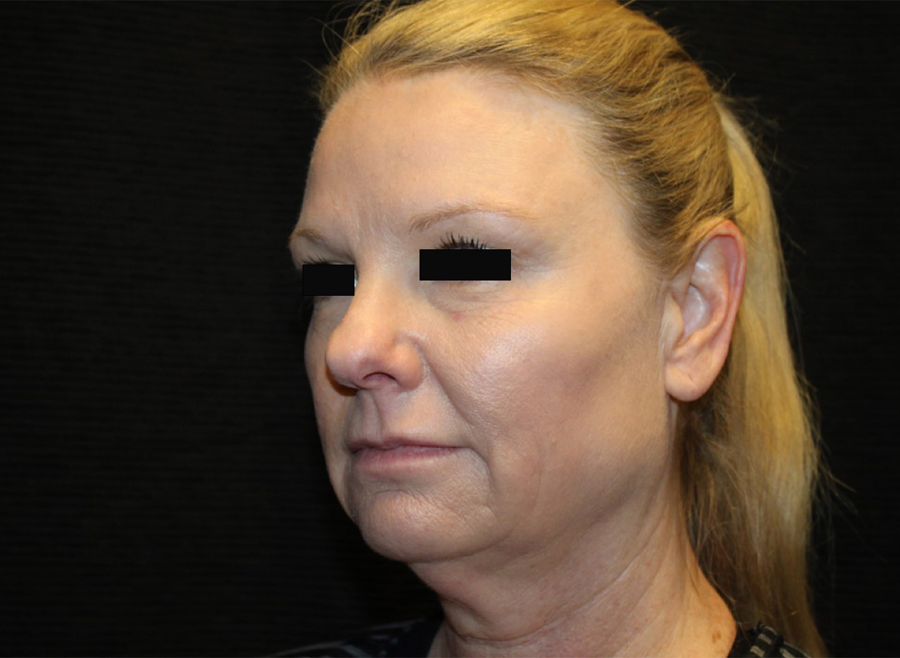Patient #33784: FaceTite & Morpheus8 Before Image