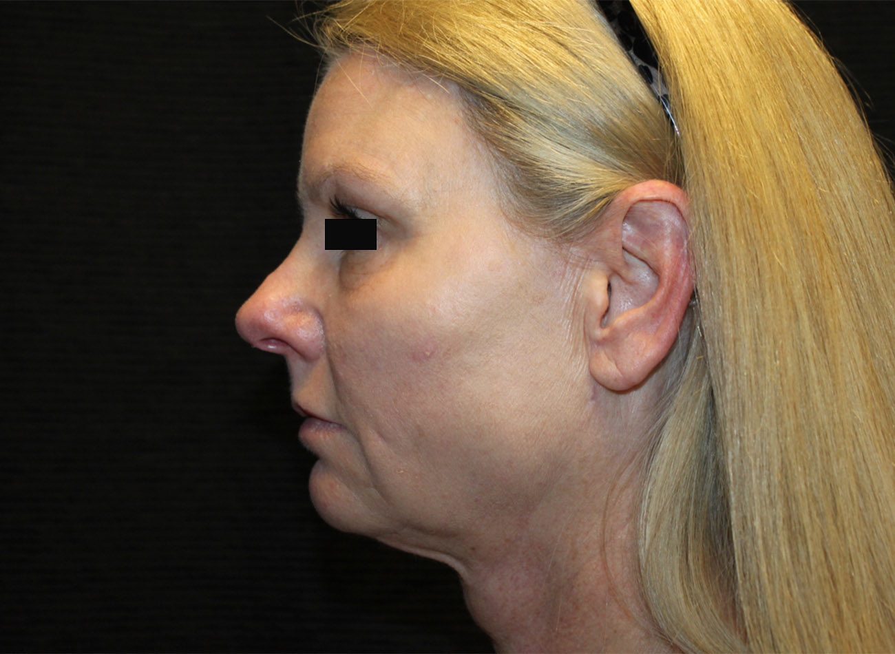 Patient #33784: FaceTite & Morpheus8 After Image