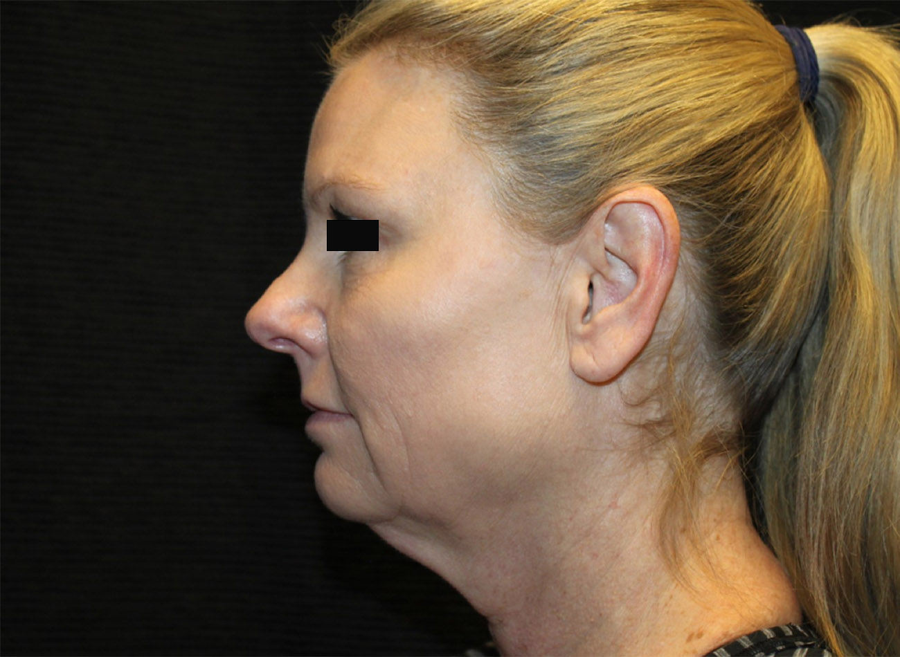 Patient #33784: FaceTite & Morpheus8 Before Image