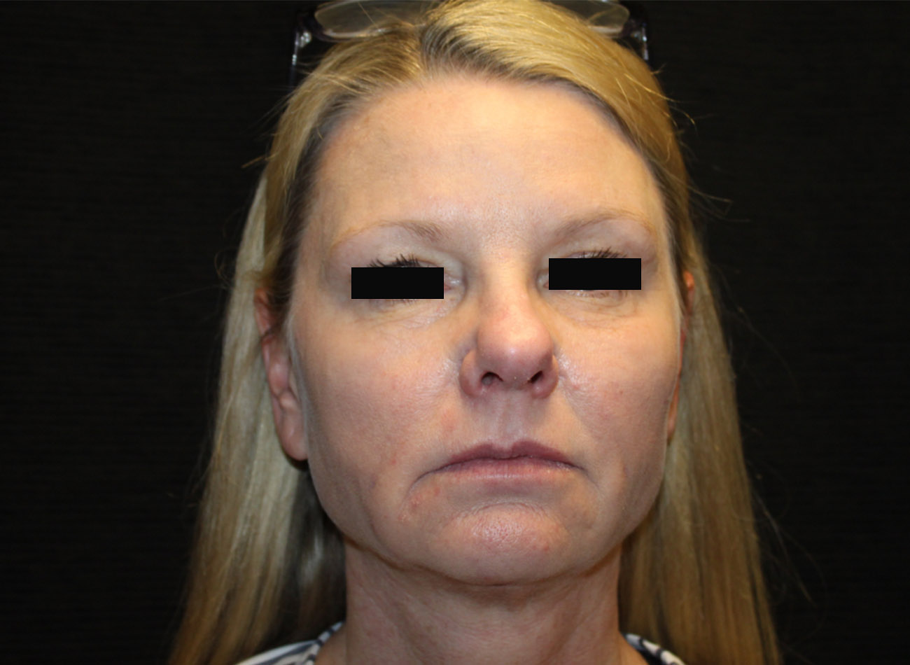 Patient #33784: FaceTite & Morpheus8 After Image