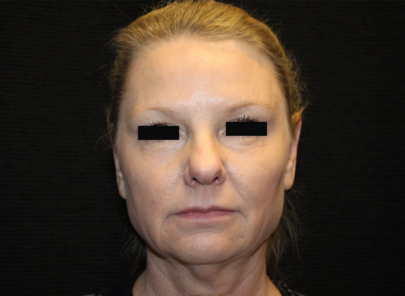 Patient #33784: FaceTite & Morpheus8 Before Image