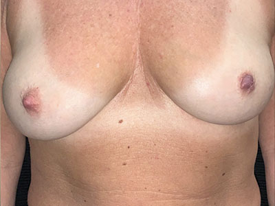 Patient #85016: Nipple Inversion After Image