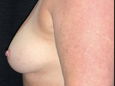 Patient #85016: Nipple Inversion After Image