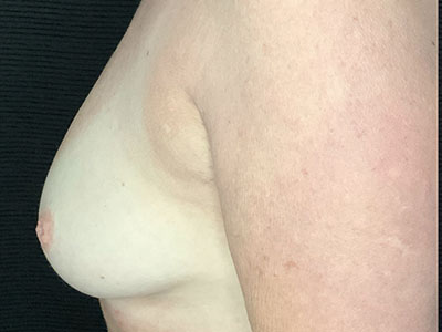 Patient #85016: Nipple Inversion Before Image