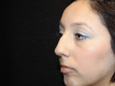 Patient #04699: Rhinoplasty Before Image