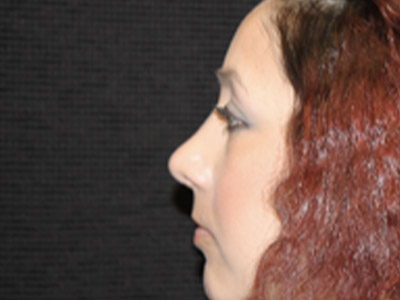 Patient #04699: Rhinoplasty After Image