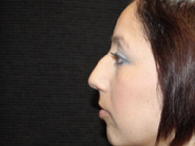 Patient #04699: Rhinoplasty Before Image