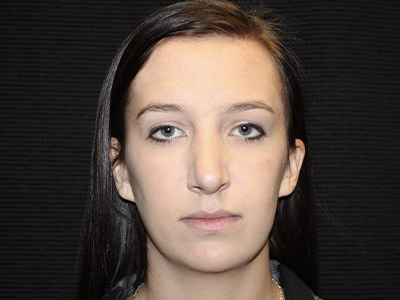 Patient #06575: Rhinoplasty After Image