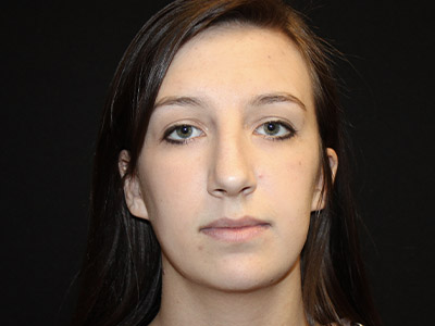 Patient #06575: Rhinoplasty Before Image