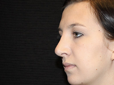 Patient #06575: Rhinoplasty After Image