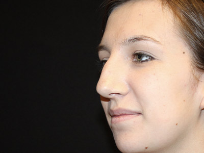 Patient #06575: Rhinoplasty Before Image