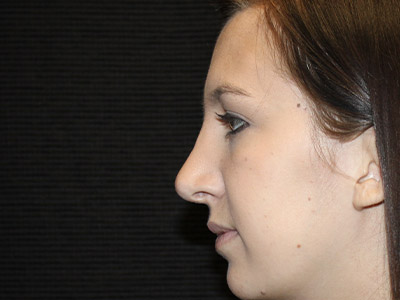 Patient #06575: Rhinoplasty After Image