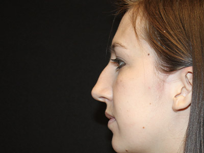 Patient #06575: Rhinoplasty Before Image