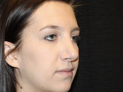 Patient #06575: Rhinoplasty After Image
