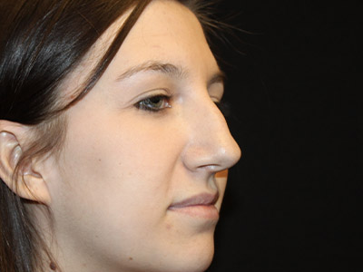Patient #06575: Rhinoplasty Before Image