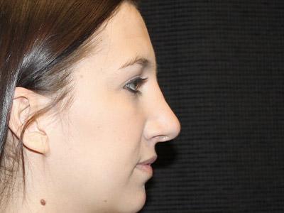 Patient #06575: Rhinoplasty After Image