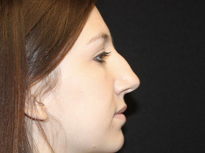 Patient #06575: Rhinoplasty Before Image
