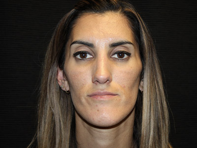 Patient #08955: Rhinoplasty After Image