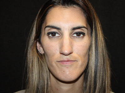 Patient #08955: Rhinoplasty Before Image