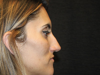 Patient #08955: Rhinoplasty Before Image