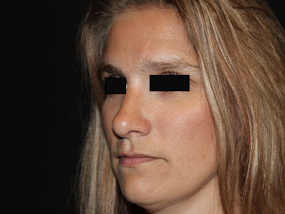 Patient #13696: Rhinoplasty After Image