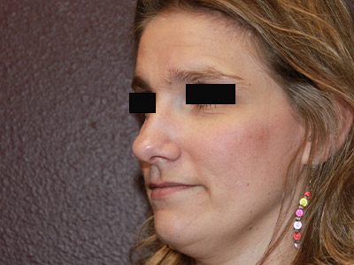 Patient #13696: Rhinoplasty Before Image