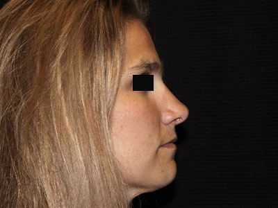 Patient #13696: Rhinoplasty After Image