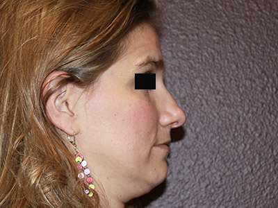 Patient #13696: Rhinoplasty Before Image