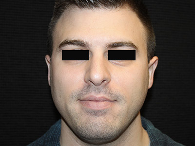 Patient #14231: Rhinoplasty After Image