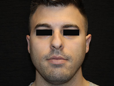Patient #14231: Rhinoplasty Before Image