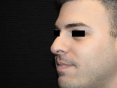 Patient #14231: Rhinoplasty After Image