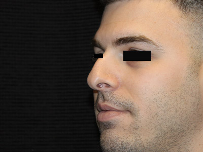 Patient #14231: Rhinoplasty Before Image
