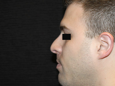 Patient #14231: Rhinoplasty After Image