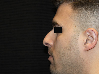 Patient #14231: Rhinoplasty Before Image
