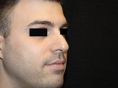 Patient #14231: Rhinoplasty After Image