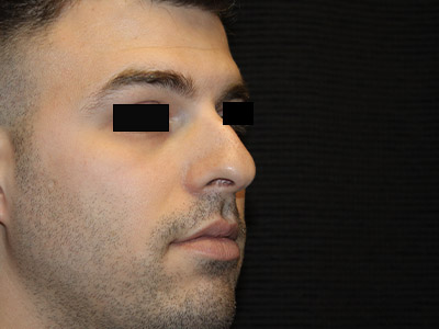 Patient #14231: Rhinoplasty Before Image