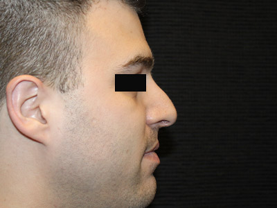 Patient #14231: Rhinoplasty After Image