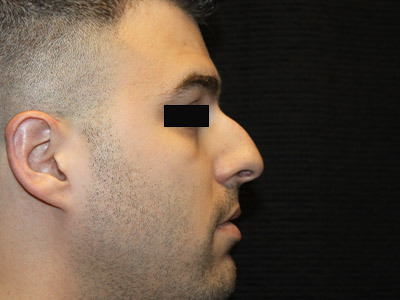Patient #14231: Rhinoplasty Before Image