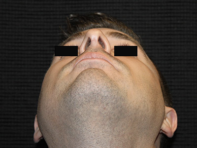 Patient #14231: Rhinoplasty After Image