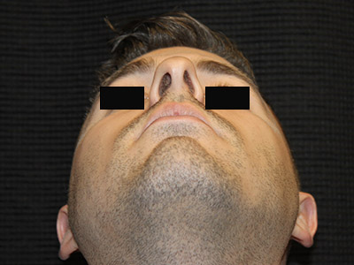 Patient #14231: Rhinoplasty Before Image