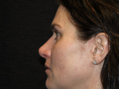 Patient #25750: Rhinoplasty After Image