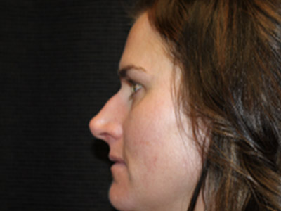 Patient #25750: Rhinoplasty Before Image
