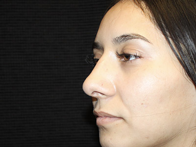 Patient #27507: Rhinoplasty After Image