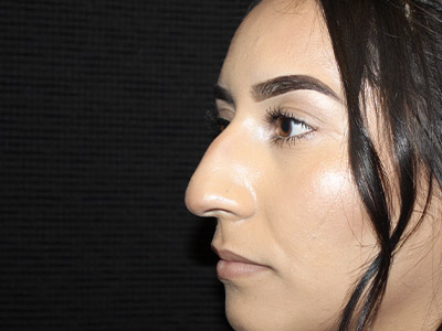 Patient #27507: Rhinoplasty Before Image