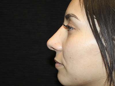 Patient #27507: Rhinoplasty After Image
