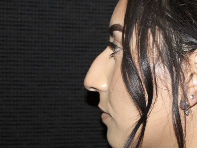 Patient #27507: Rhinoplasty Before Image