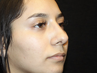 Patient #27507: Rhinoplasty After Image