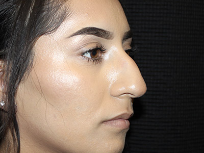 Patient #27507: Rhinoplasty Before Image